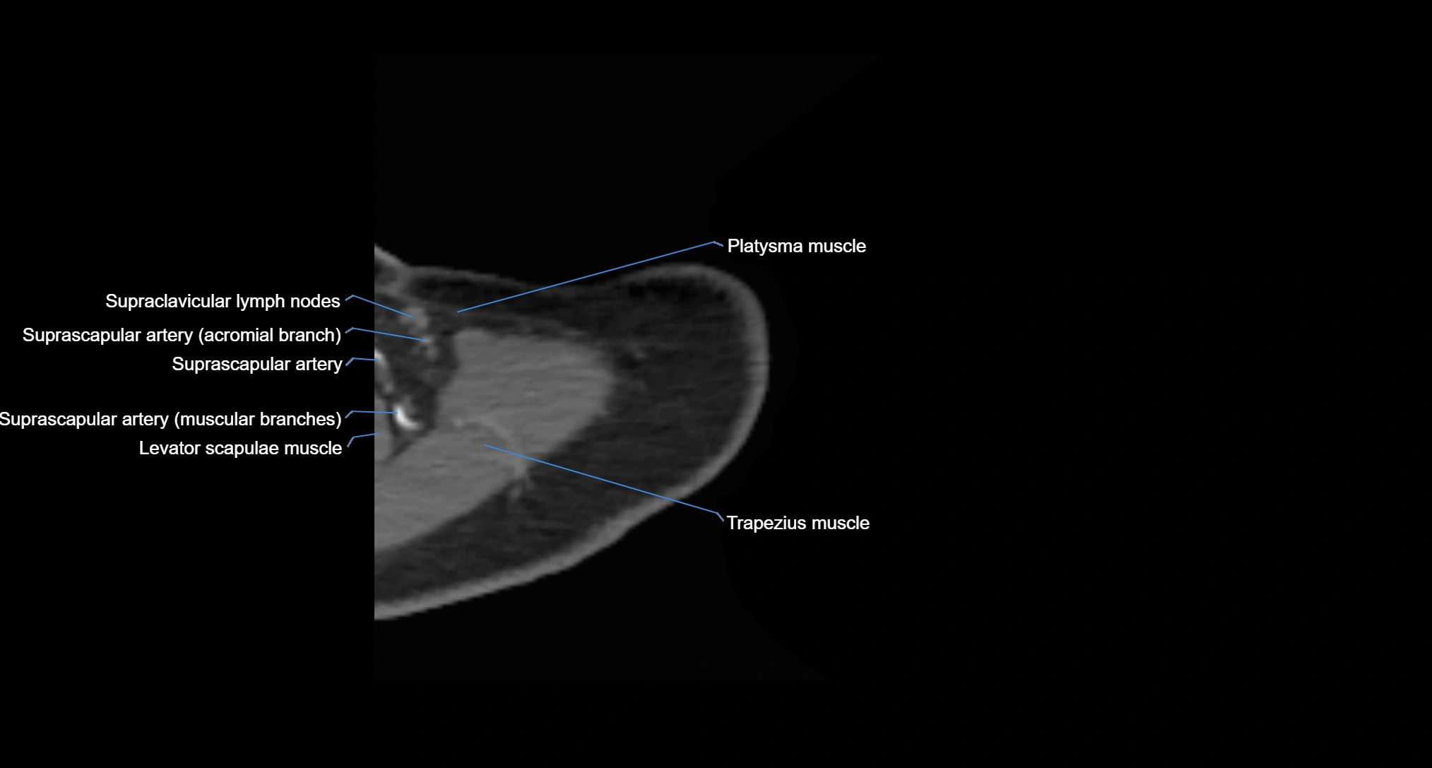 CT Shoulder axial cross sectional anatomy labelled radiology image -00006.webp